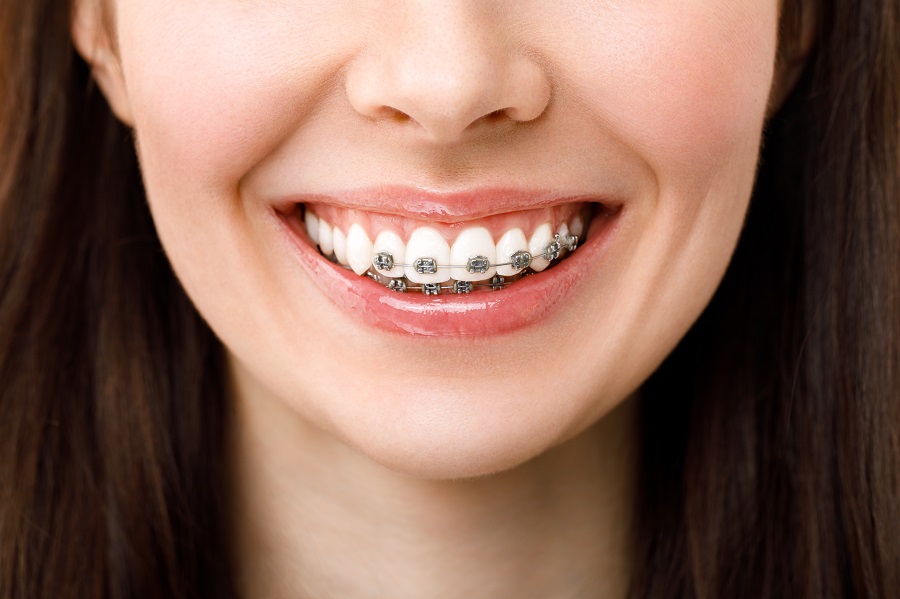 How Do Braces Work?