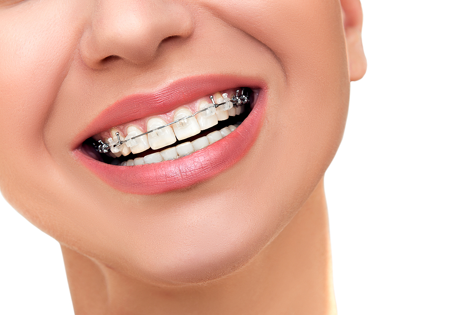 Get Straighter Teeth Fast with Braces (In One Day) in Bowling Green, KY