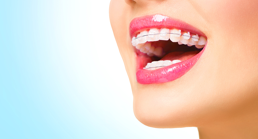 Get a Straighter Smile Quickly: Braces (In One Day)